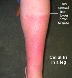 cellulitis